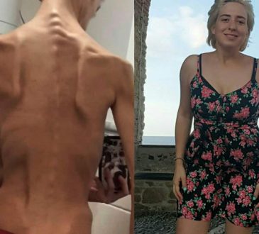 francesco ex anoressia