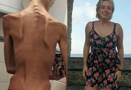 francesco ex anoressia